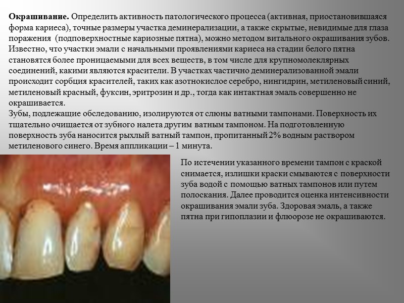 Окрашивание. Определить активность патологического процесса (активная, приостановившаяся форма кариеса), точные размеры участка деминерализации, а